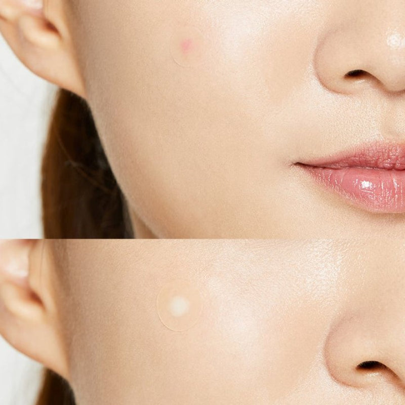 COSRX Acne Pimple Master Patches - Korean-Skincare
